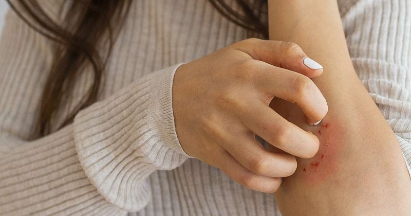 A skin rash could be symptomatic of Coronavirus - TVMnews.mt